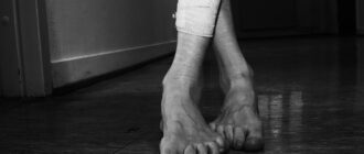 молоткообразные пальцы ног лечение и корректоры