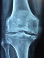 Бандаж на колено – эффективное средство от боли в суставах