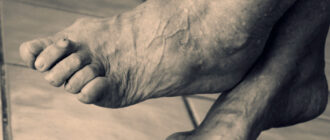 лечение вальгусной деформации пальца